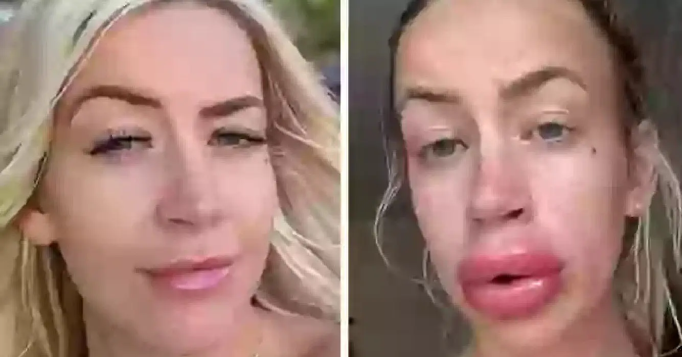 Lippen van vrouw gaan van kwaad tot erger nadat filler oplost 