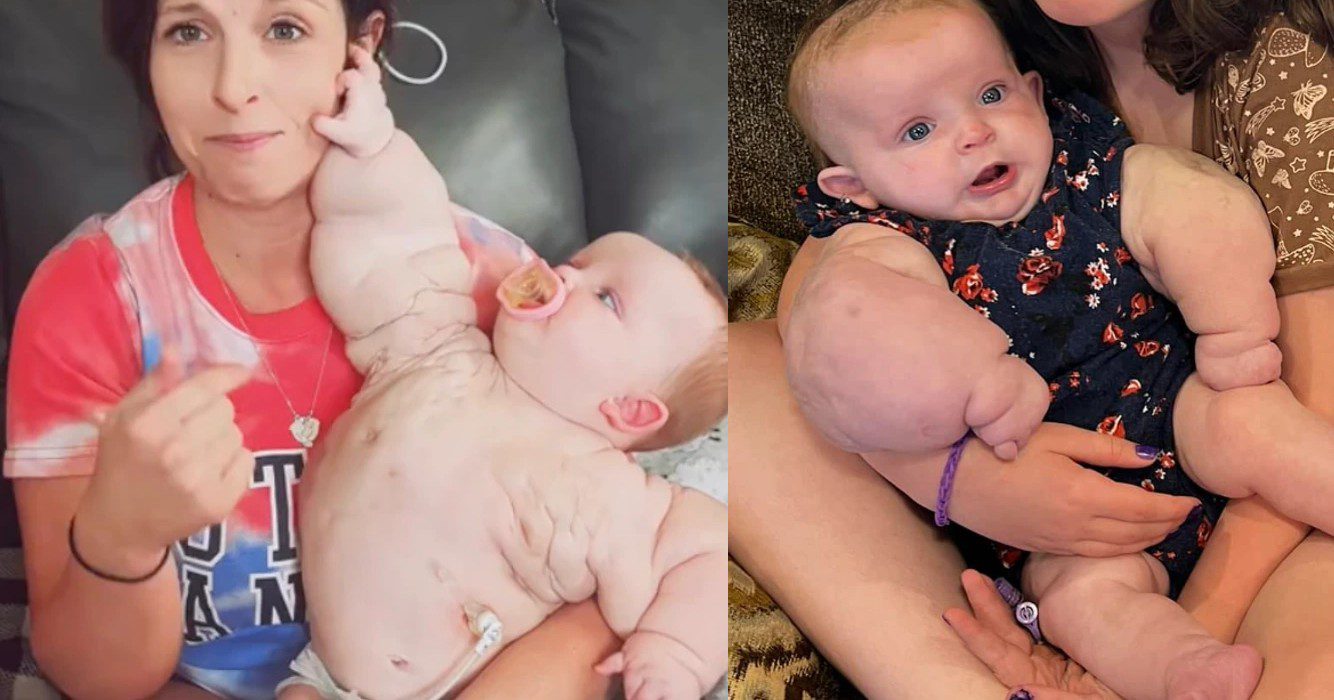 Baby hulk met zeldzame aandoening verslaat alle kansen het is een heel magisch verhaal