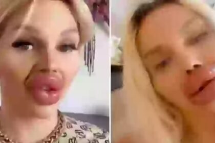 Vrouw met 30 ml lipfiller geeft toe dat ze het lastig vindt om te eten en drinken