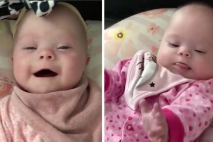 Moeder verwelkomt uiterst zeldzaam type tweeling met syndroom van down