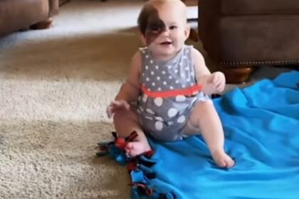 moeder hoopt te laten zien dat verschillen mooi zijn door zeldzame moedervlek dochter te delen