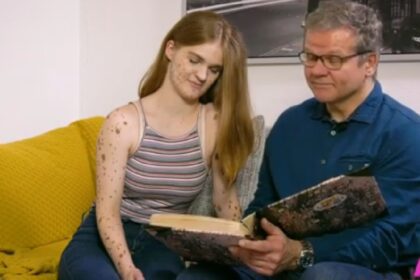 Meisje wordt jarenlang gepest vanwege haar moedervlekken nu is ze een model