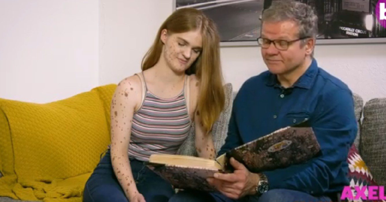 Meisje wordt jarenlang gepest vanwege haar moedervlekken nu is ze een model